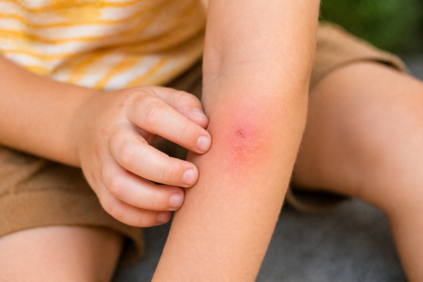Die 12 häufigsten Allergien bei deinem Kind erkennen. 